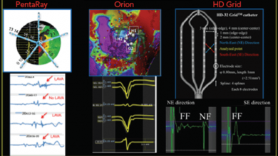Impact of Micro-, Mini- and Multi-Electrode Mapping on Ventricular Substrate Characterisation