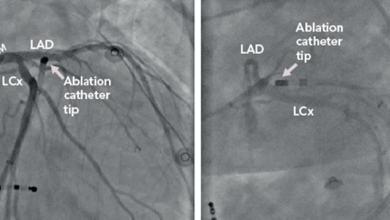 Hybrid Catheter-Based and Surgical Techniques for Ablation of Ventricular Arrhythmias