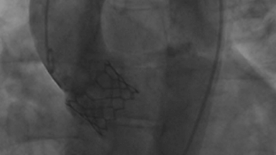 Management of Valvular Disease During Pregnancy: Evolving Role of Percutaneous Treatment