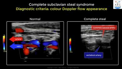 Complete Subclavian Artery Steal Syndrome: ultrasound criteria