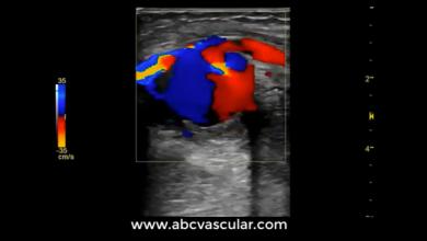 Pseudoaneurysm of the brachial artery: vascular ultrasound