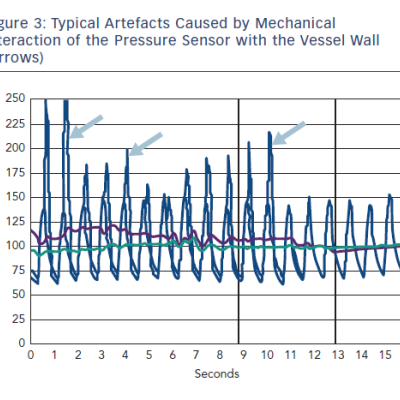 Figure 3 Typical Artefacts Caused by Mechanical&ampltbr /&ampgt&amp10Interaction of the Pressure Sensor with the Vessel Wall&ampltbr /&ampgt&amp10Arrows