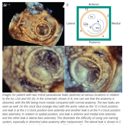 Figure 2 Location and Sizing of Mitral Paravalvular Leaks