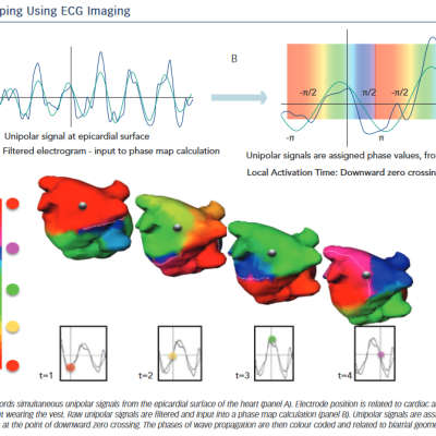 Phase Mapping Using ECG