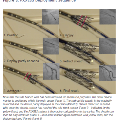 Figure 3 AXXESS Deployment Sequence