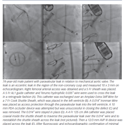 Figure 3 Aortic Paravalvular Leak Single Device