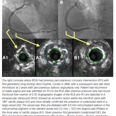 Stent Failure Secondary to Undersized Stent