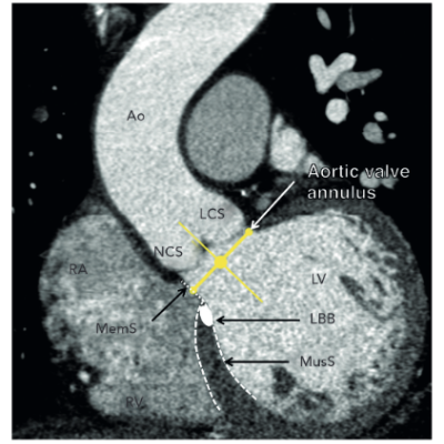 Relationship of the Left Bundle Branch with the Aortic Root