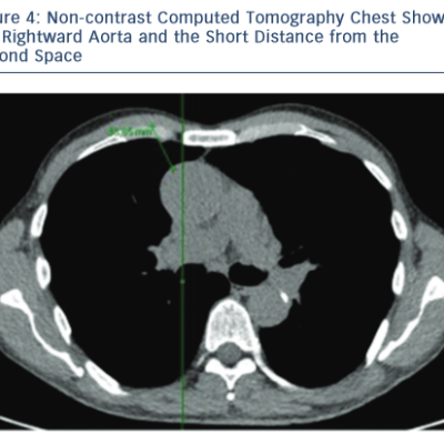 Image showing The Rightward Aorta and The Short Distance from the Second Space