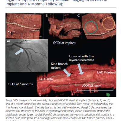 Figure 5 Optical Frequency Domain Imaging of Axxess at Implant and 6 Months Follow Up