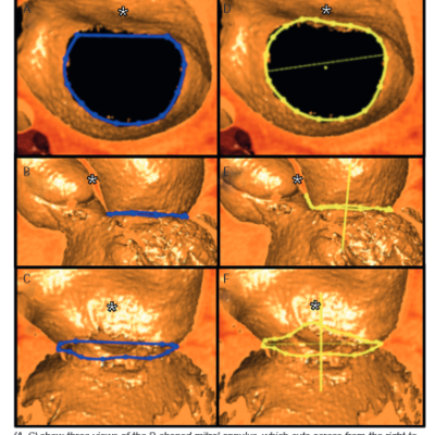 Image of Mitral Valve Annulus