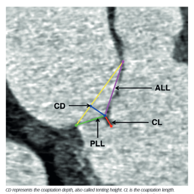 Figure of Mitral Valve Leaflets