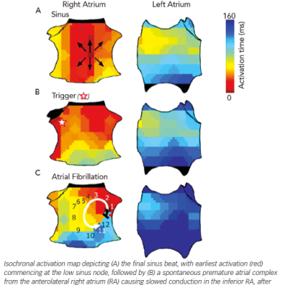 AF Initiation via a Rotor in an 81 old Man with Paroxysmal AF