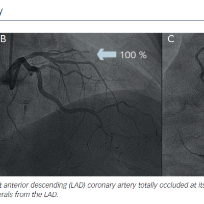 Diagnostic Coronary Angiography