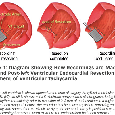 Figure 1 Diagram Showing How Recordings are Made Pre- and Post-left Ventricular Endocardial Resection for Treatment of Ventricular Tachycardia