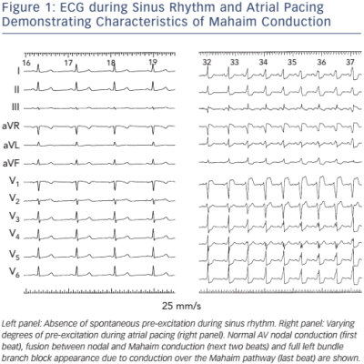 Figure 1 ECG during Sinus Rhythm and Atrial Pacing Demonstrating Characteristics of Mahaim Conduction