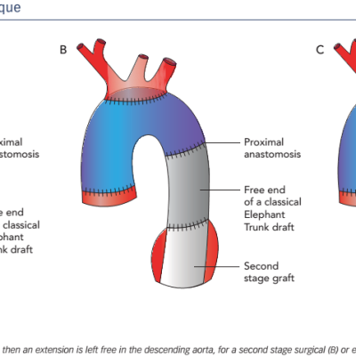 Figure 1 Elephant Trunk Technique