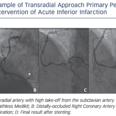 Figure-1-Example-of-Transradial-Approach-Primary-Percutaneous-0