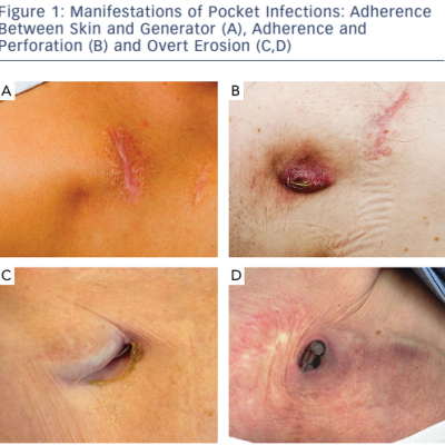 Figure-1-Manifestations-of-pocket-infections