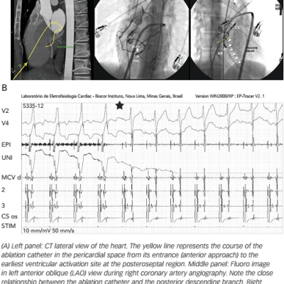 Figure 1 Percutaneous Epicardial Ablation of a Posteroseptal Accessory Pathway