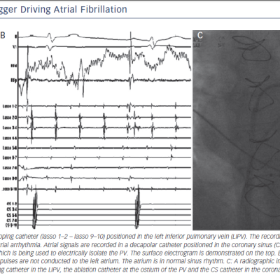 Pulmonary Vein Trigger Driving AF