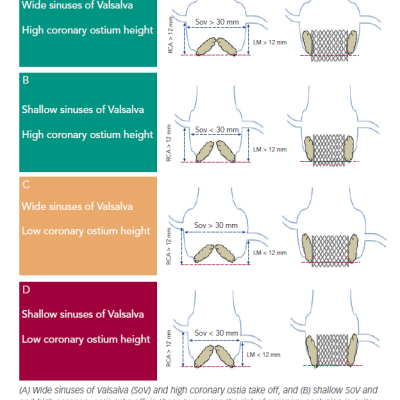 Figure 1 Schematic Representation of Four Aortic Root Scenarios