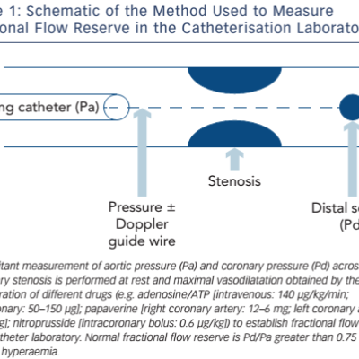 Figure 1 Schematic of the Method Used to Measure Fractional Flow Reserve in the Catheterisation Laboratory