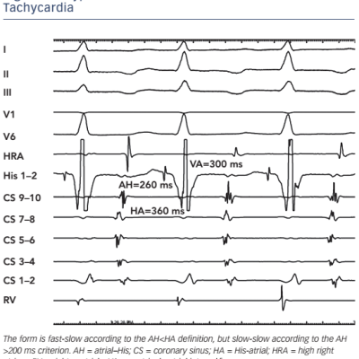 Figure 2 Atypical Atrioventricular Nodal Reentrant Tachycardia