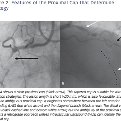 Figure 2 Features of the Proximal Cap that Determine Strategy