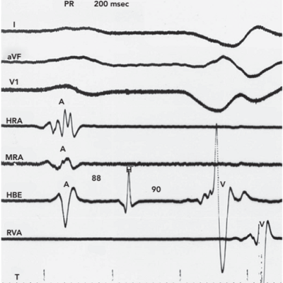 Figure 2 Markedly Prolonged H-V Interval in the Presence of a Normal Overall P-R Interval