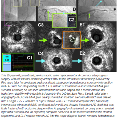 Stent Failure Secondary to Probable Stent Fracture in Mid-LAD Stents