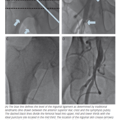 Figure 2 Technique to Optimise Femoral Arterial Access