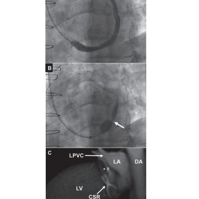 Figure 2 The Coronary Sinus Reducer Device