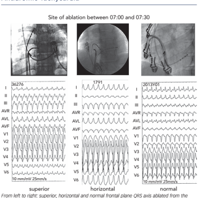 Figure 3 12-lead ECG of Three Different Patients with Antidromic Tachycardia