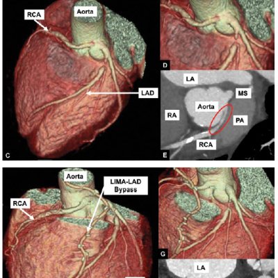 A Case Of Restrosternal Pressure And Burning