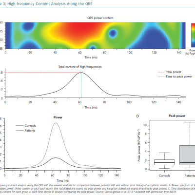 High-Frequency Content Analysis Along The QRS