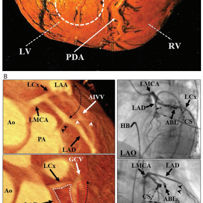 Figure-3-the-sites-of-epicardial-idiopathic