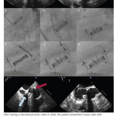 Figure 4 Aortic Paravalvular Leak Multiple Leaks