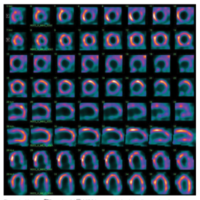 Extensive Left Ventricular Adrenergic Denervation And Preserved Myocardial Perfusion