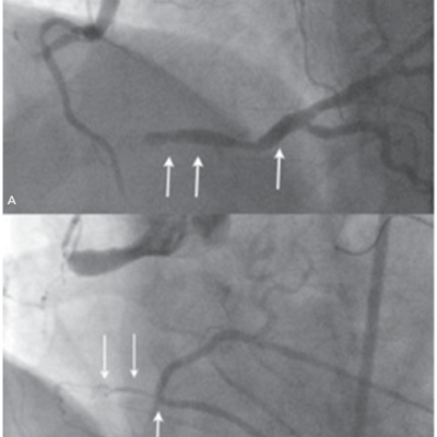 Figure 4 Features of Distal Landing Zone that Determine Strategy