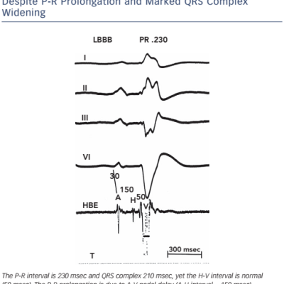 Figure 4 Normal H-V Interval in Left Bundle Branch Despite P-R Prolongation and Marked QRS Complex Widening