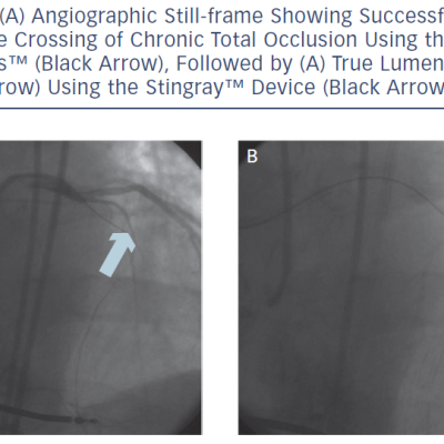Angiographic Still-Frame