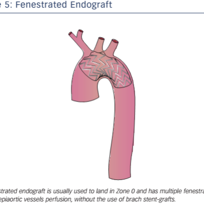 Fenestrated Endograft