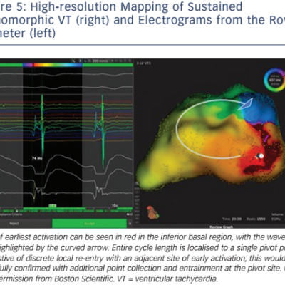 High-resolution Mapping of Sustained Monomorphic VT right and Electrograms from the Roving Catheter