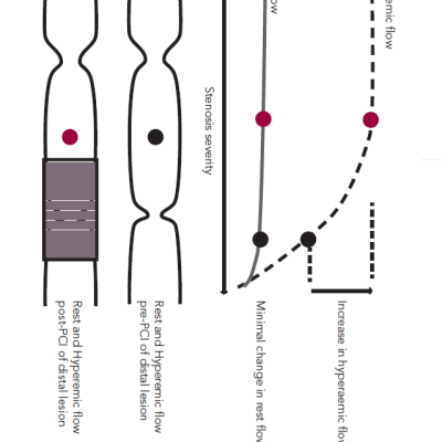 Figure 5 How Resting Flow and Hyperaemic Flow Vary with Stenosis Severity and the Impact on Tandem Lesion Assessment