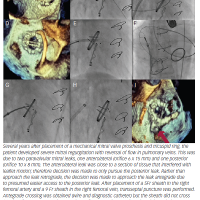 Figure 5 Mitral paravalvular leak one device