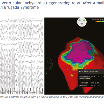 Sustained Polymorphic Ventricular Tachycardia Degenerating To VF