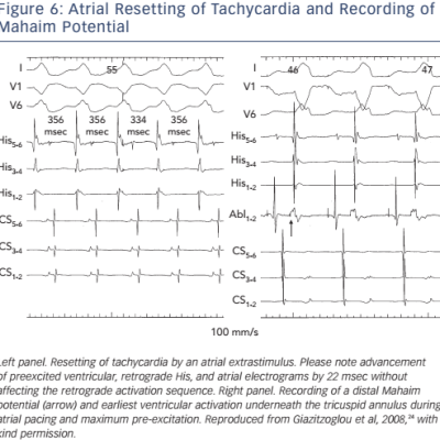 Figure 6 Atrial Resetting of Tachycardia and Recording of Mahaim Potential