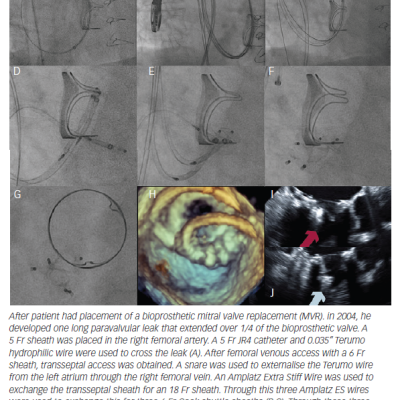 Figure 6 Mitral Paravalvular Leak Multiple Leaks