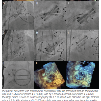 Figure 7 Mitral Paravalvular Leak Multiple Leaks